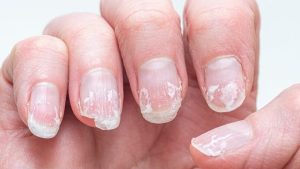 HT17. Rippled fingernails reveal secrets of possible disease