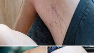 HT17. If you have purple veins on your legs, it means you are…