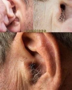 HT13. Why Do Humans Have Ear Hair? Understanding Causes and Care