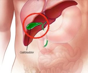 HT17. What happens to your body after gallbladder is removed