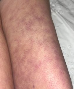 HT17. What Those Strange Skin Patterns Might Really Mean