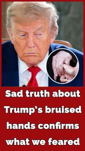 ST15. Trump shows off ‘wrinkled hands’ amid latest health fear