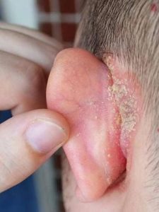 HT13. I noticed a strange patch of skin on my sons ear, and with his doctor appointment still a week away