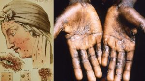 ST15. The Scariest Diseases in Human History: When Illness Reshaped Civilization