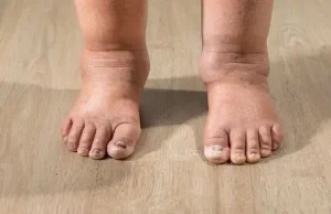 HT13. Health Warning Signs on Your Feet You Should Never Ignore