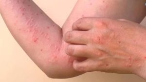 HT17. ALERT: New Disease Outbreak in China — Over 7,000 Cases Reported, Symptoms and Risks Revealed…