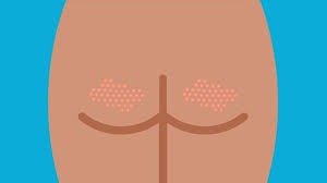 ST17. Pimples on the Buttocks: What You Need to Know