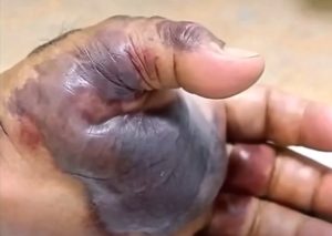 HT17. Blackened Hand Highlights the Hidden Dangers of Untreated Infections