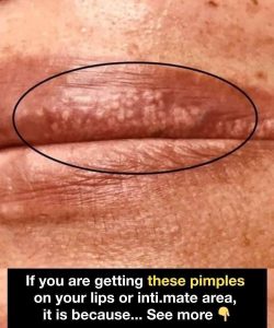 HT17. If you are getting these pimples on your lips or intim:ate area, it is because… See more