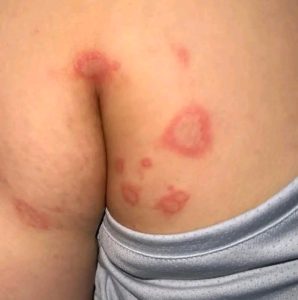 HT17. Why Bumps Appear in the Gen!tal Area