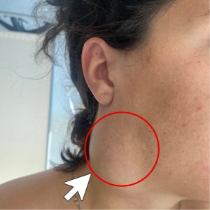 HT17. Branchial Cleft Cyst: Causes, Symptoms, Diagnosis, and Treatment