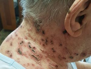 HT17. This is the silent disease that is triggered when you come into contact with … See more