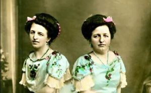 HT17. The Incredible Story of the Siamese Twins: One Fell in Love, Had a Baby — and Both Became Mothers…