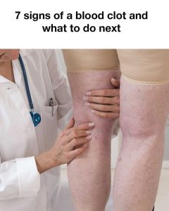 HT17. 7 Warning Signs of a Blood Clot — When to Seek Medical Care