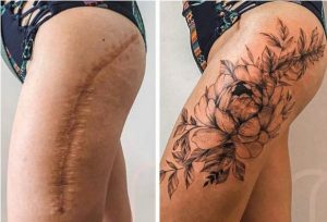ST17. Tattoos can help you turn scars into something beautiful