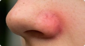 HT17. The skin around my nostrils stays red and sore, and I can’t get checked yet