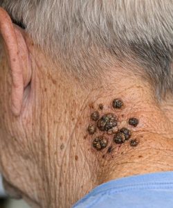 HT13. BE CAREFUL, if you get these bumps on your body, it means you have ca…see more
