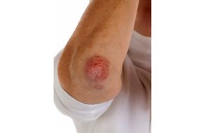 HT17. My elbows keep getting itchy scaly patches where clothing rubs, and I won’t see a doctor for weeks. What helps now?