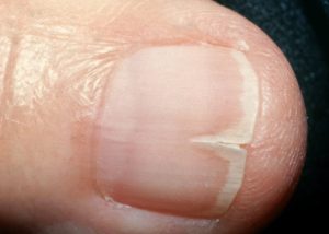 HT17. My fingernails keep splitting straight down instead of chipping. What causes this?