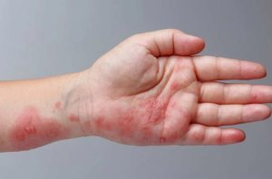 HT17. My hands get itchy and red under gloves, and my appointment is far off. What helps now?