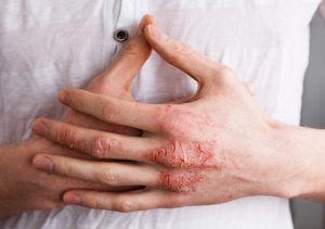 HT17. My knuckles keep cracking open and burning in cold weather, and I can’t get medical advice yet