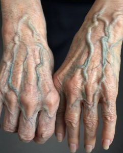 HT17. If your veins are visible in your hand, it is a signal of ca…