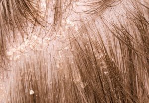 HT17. My scalp itches nonstop even though it looks clean, and my appointment is weeks away