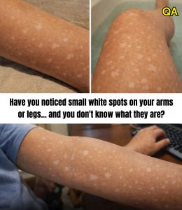 HT4. Have you noticed small white spots on your arms or legs… and you don’t know what they are?