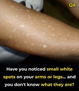 HT4. Have you noticed small white spots on your arms or legs… and you don’t know what they are?