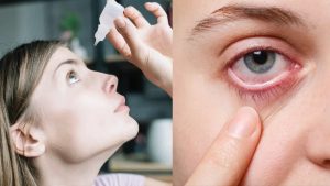 ST13. Understanding Eye Infections: Causes, Symptoms, and Effective Treatments