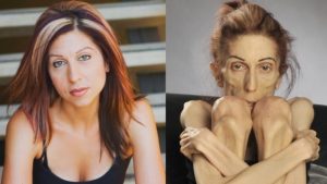 ST19. The World’s Thinnest Woman’s Battle Against Anorexia Will Leave You Speechless