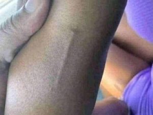 HT4. Found this in my girls arm still trying to figure out what it is