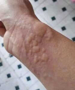 HT4. The Hidden Danger on Your Skin: Why Hives and Breathing Changes Are Serious Warning Signs You Should Never Ignore