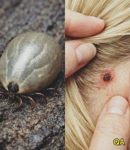 HT19. Found a Weird Bug in Your Child’s Hair? Important Info for Parents