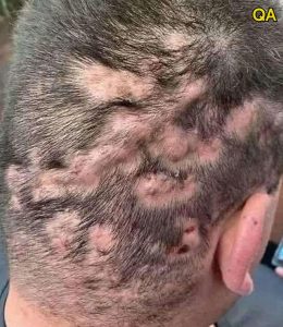 HT17. These are the first symptoms