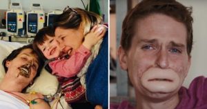 ST4. Dad left unrecognizable after losing his lips and four limbs to flesh-eating bug