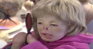 ST4. Toddler gets 90 percent burns and survives house blaze against all odds