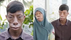ST15. The Manurung Family’s Rare Facial Condition Is Inspiring Millions Worldwide