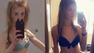 ST4. A woman from Derbyshire has shared her recovery journey from anorexia, finding strength through running and rebuilding self-worth.