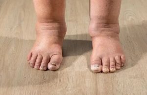 HT4. Health Warning Signs on Your Feet You Should Never Ignore