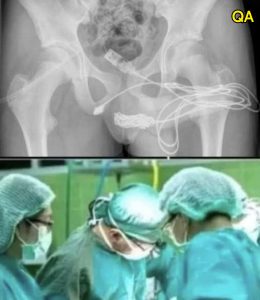 HT15. Girl had to be hospitalized for wanting to use a pe…See more