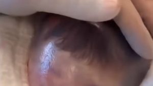 HT4. Baby born with an DIU peg… See more