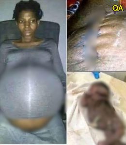 HT4. A 30-year-old woman in Georgia was declared brain dead