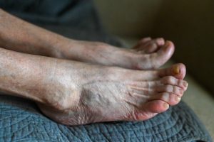HT16. Unusual Changes in Your Feet That Doctors Say May Be Linked to Circulation Health