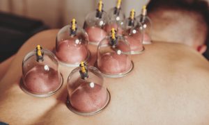 ST4. What Is Cupping Therapy? Benefits, Types, and Safety Tips