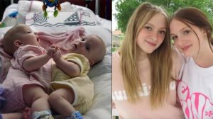 ST13. Conjoined Twins Who Were Separated Through Surgery Almost 18 Years Ago Are Living Life Like Normal Teenagers Today