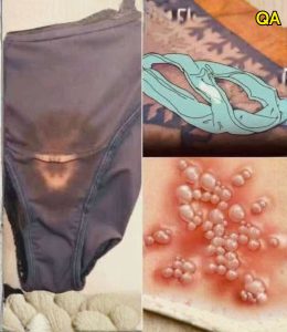 HT4. Why You May Notice Bleach-Like Stains on Your Underwear: Causes, Concerns, and When to See a Doctor