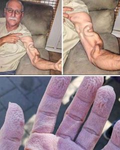 HT16. A man goes to stretch and ends up feeling a sharp pain in his arm, it was a ca… See more