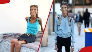 ST4. World’s Thinnest Woman Receives Fan Mail to Be Like Her