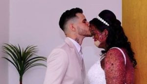 HT15. Woman with rare skin condition overcomes negativity and finds true love